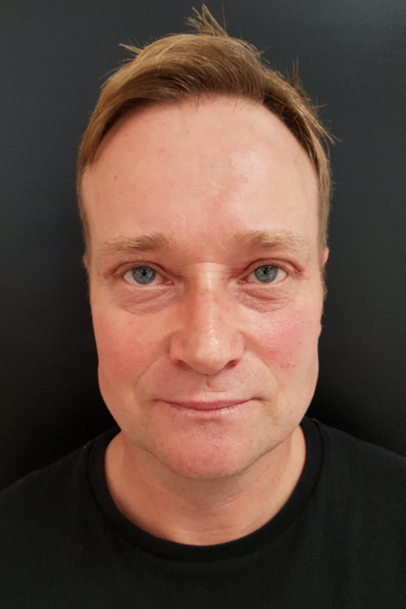 Blepharoplasty-Postop-2