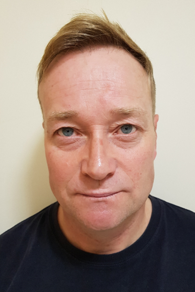 Blepharoplasty-Preop-2 Blepharoplasty-Preop-2